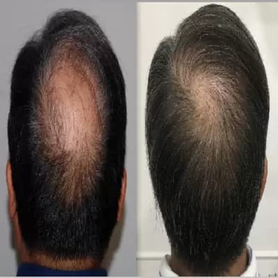 Moderne Haartransplantationen haben deutliche Fortschritte gemacht