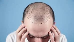 Moderne Haartransplantationen haben deutliche Fortschritte gemacht