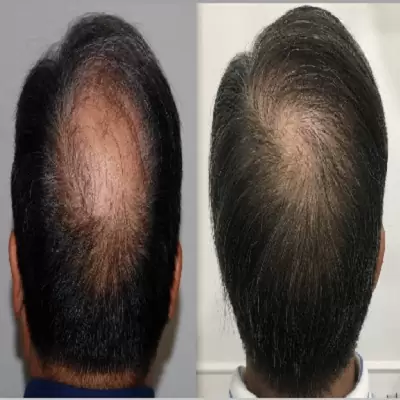 Moderne Haartransplantationen haben deutliche Fortschritte gemacht
