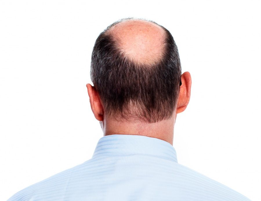 Haarwurzelentzündung bekämpfen: Tipps für eine erfolgreiche Therapie
