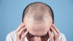 Moderne Haartransplantationen haben deutliche Fortschritte gemacht