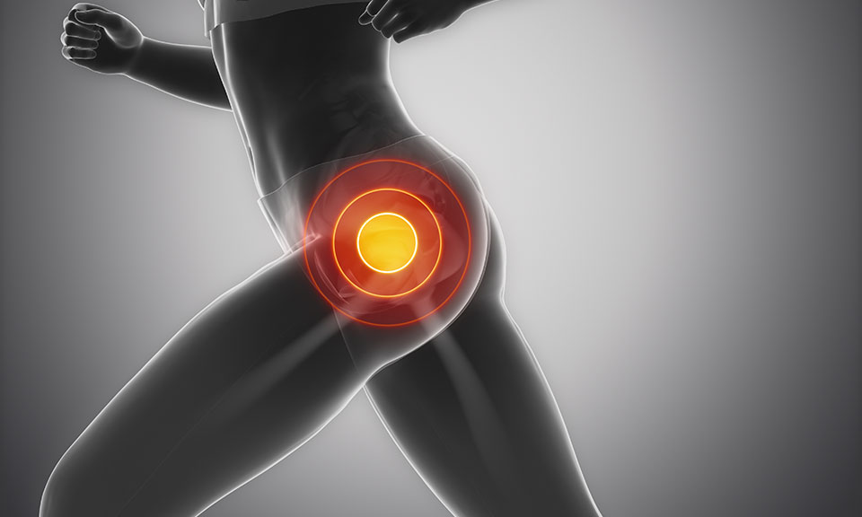 Warum Hüftschmerzen selten durch Arthrose entstehen – und was wirklich dahintersteckt
